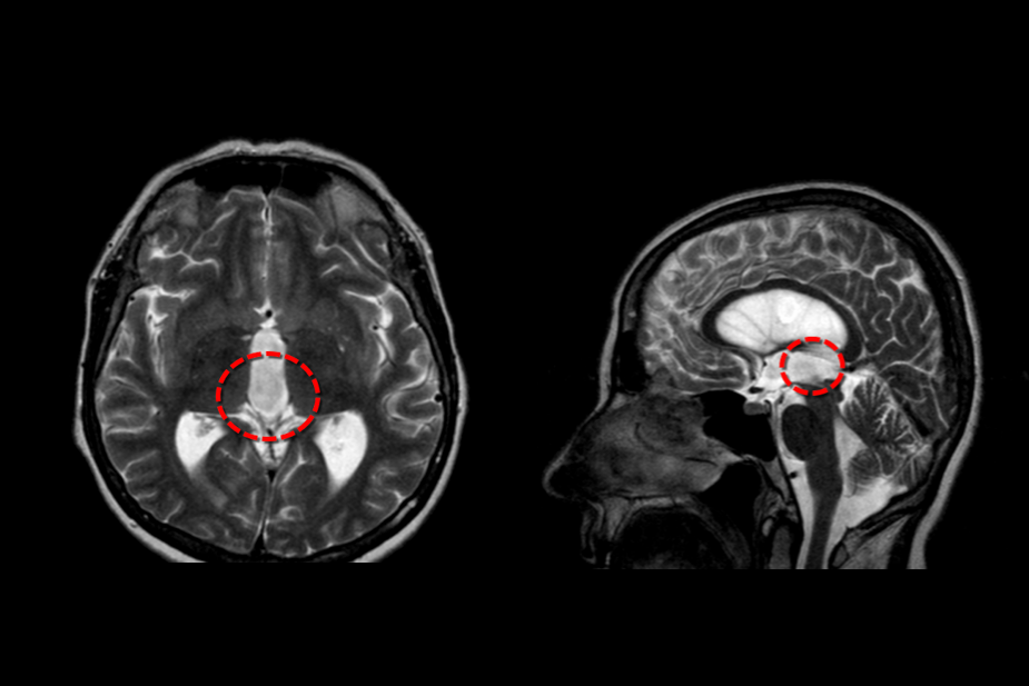 Признаки опухоли головного мозга, и симптомы на ранних стадиях