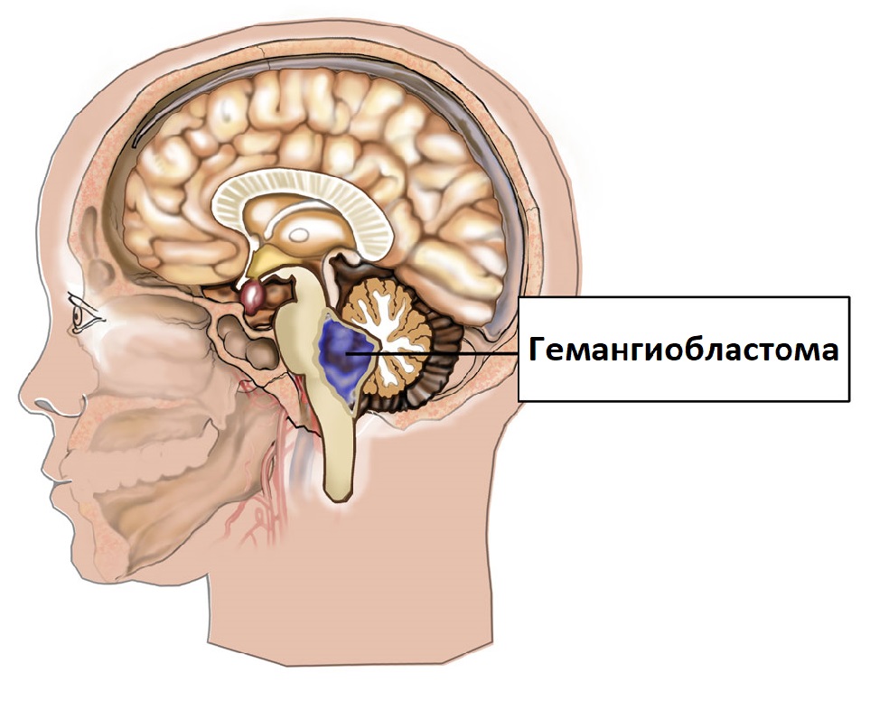 Рак ствола головного мозга. Опухоль головного мозга гемангиобластома. Гемангиобластома (ангиоретикулема).