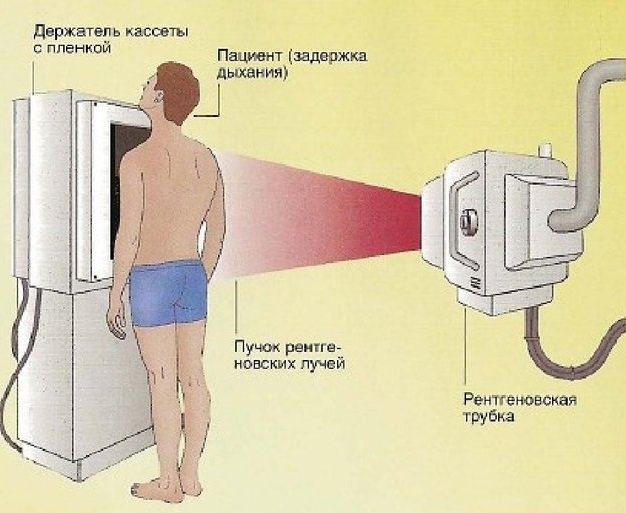 Плеврит легких при онкологии: симптомы, лечение и прогноз