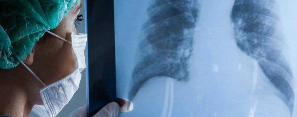 врач рассматривает рентген грудной клетки