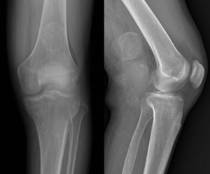 Синовиома коленного сустава симптомы thumbnail