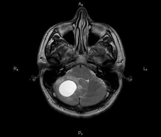 Гемангиобластома головного мозга: симптомы и лечение