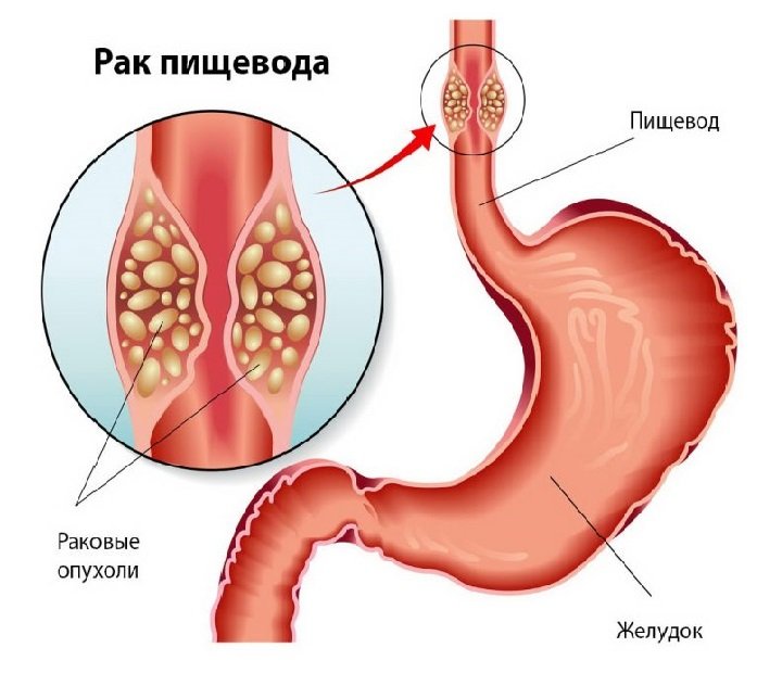 Рак пищевода - первые симптомы, признаки и лечение