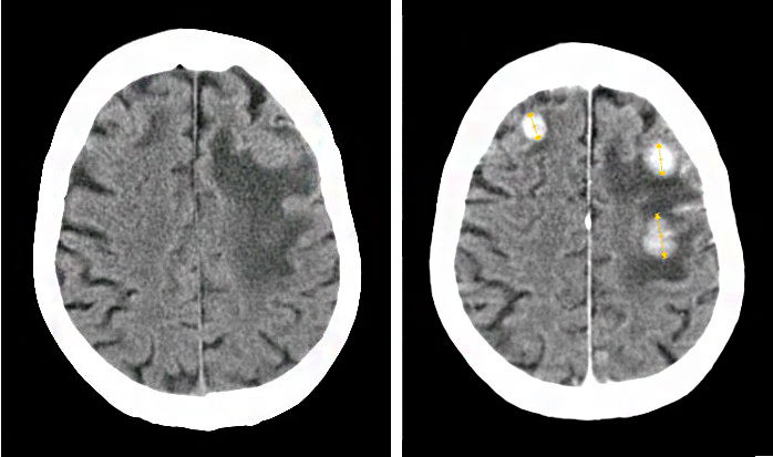 Метастазы в голове - симптомы, лечение и продолжительность жизни