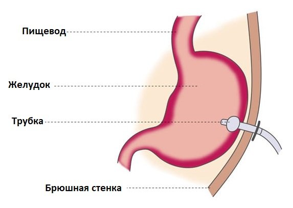 Рак пищевода онкология презентация