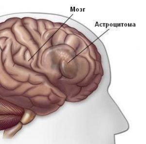 астроцитома головного мозга