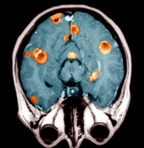 Симптомы метастаз в головной мозг и инсульт thumbnail