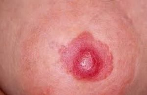 При раке Педжета поражению подвергается сосковая область груди