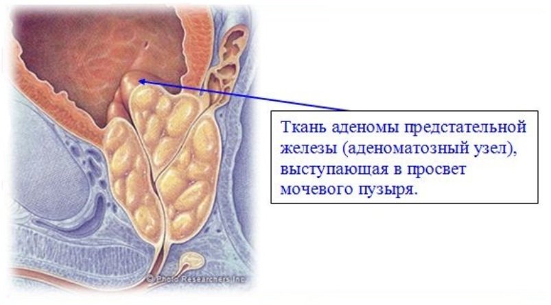 Узел в простате. Аденоматозный узел простаты. Аденоматозные узлы предстательной железы. Предстательная железа аденома простаты.