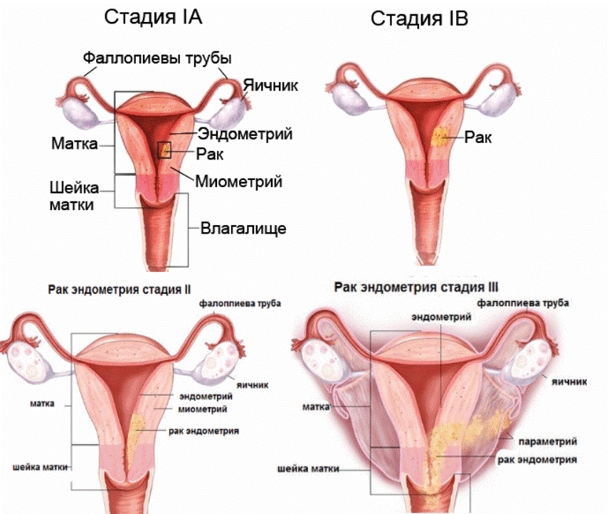 Рак 0 матки. Онкология эндометрия матки 1 стадия. Степени аденомиоза матки. Степени онкологии шейки матки.