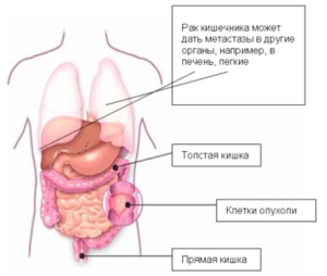 Рак кишечника метастазы
