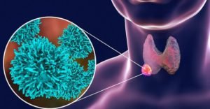 Лечение папиллярного рака щитовидной железы thumbnail