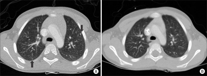 Опухоль Вильмса - симптомы, лечение, прогноз и фото