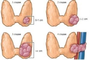4 стадии папиллярного рака щитовидной железы