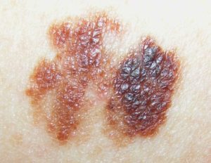 меланома - вид кожной онкологии