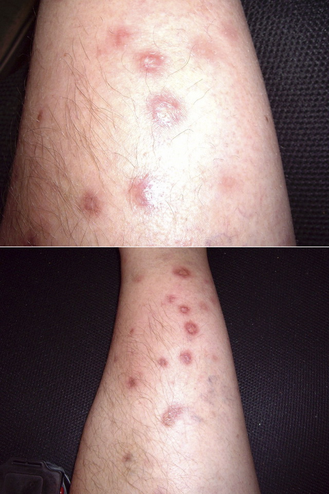 Саркоидоз кожи - что это такое, симптомы и причины