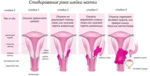 Стадирование рака шейки матки