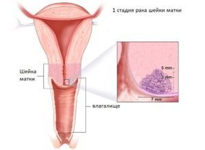 Плоскоклеточный рак шейки матки
