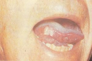 Эритроплазия Кейра полости рта - фото