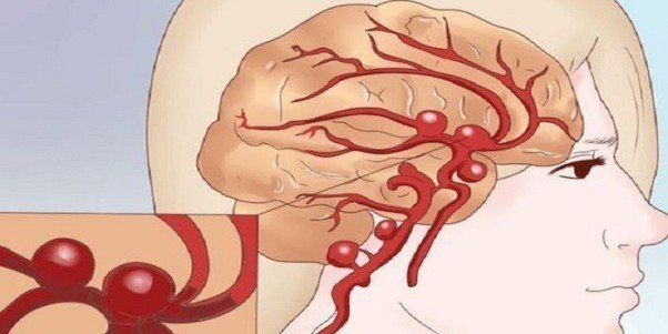 Кровоизлияние в головном мозге