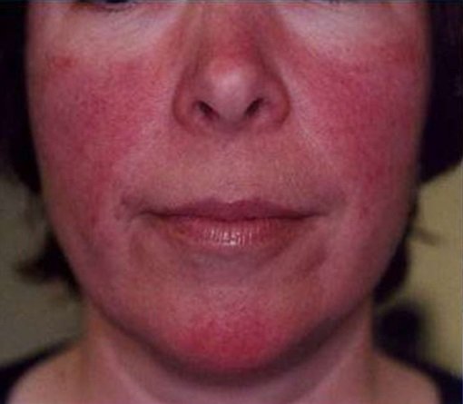 Эритремия - что это такое, симптомы, лечение и прогноз