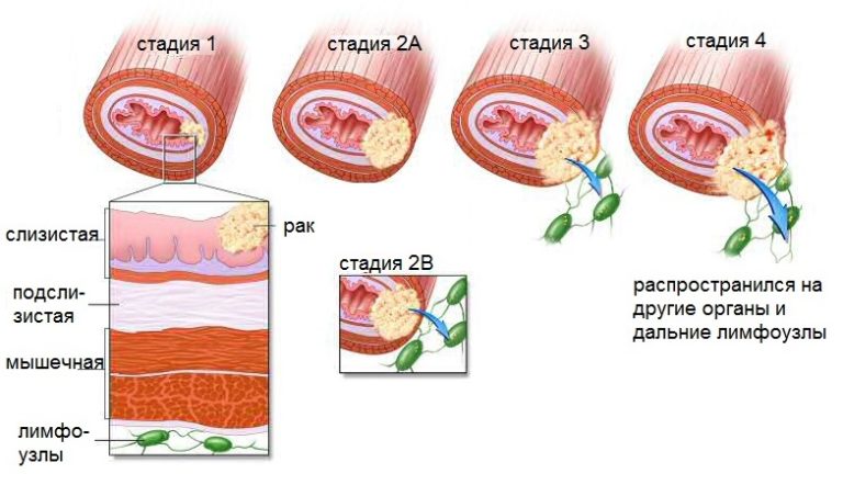 Как выглядит рак пищевода фото