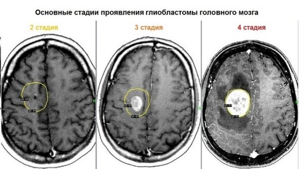 Стадии рака головного мозга