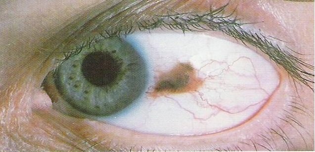 Причина возникновения меланомы глаза thumbnail