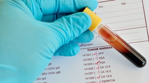 Исследование анализа крови на онкомаркеры