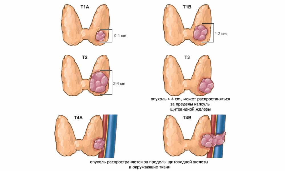 Злокачественная опухоль щитовидной железы
