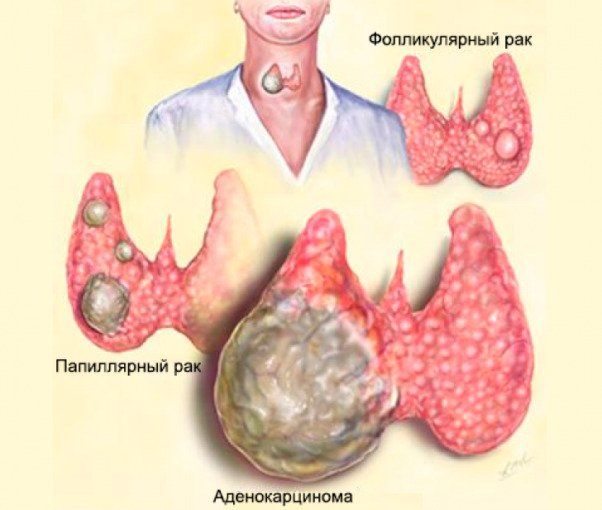 Папиллярный рак щитовидной железы