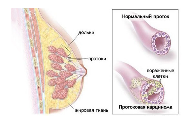 Карцинома молочной железы