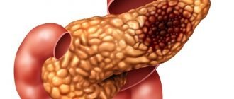 Новые подтипы рака поджелудочной железы